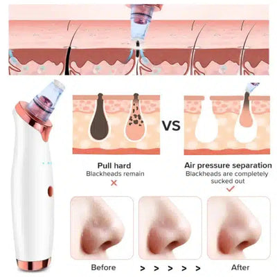 Vacuum Blackhead Remover & Pimple Spot Cleaner eGood